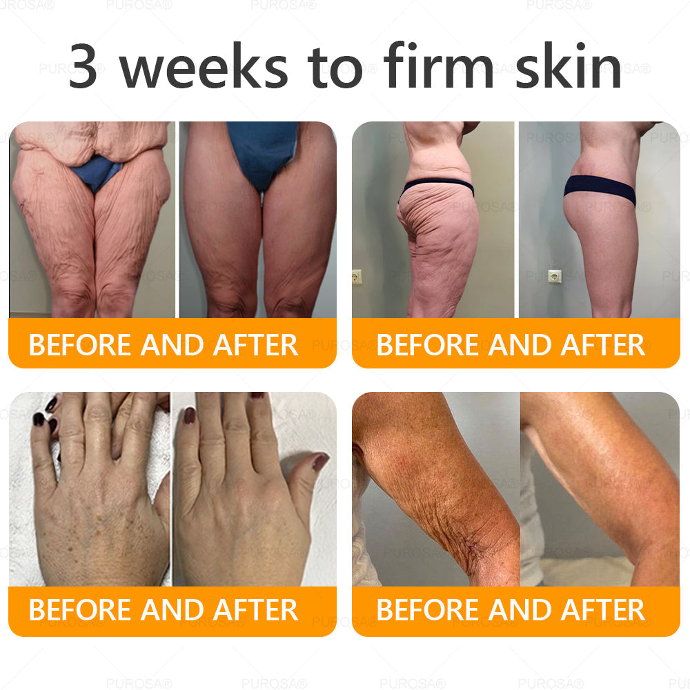 Limited to 10 jars! 🌟PUROSA®—Exclusive 30% discount, restore your skin's youthful glow in just 1-3 weeks! A rare opportunity — won’t be available again until next year, don’t miss out!180-day money-back guarantee, full refund with no risk!