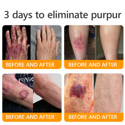 PUROSA® Bee Venom Skin Repair Cream(Visible results in 7 days✅Anti-Aging·Firming·Deep Hydration·Damage Repair·Even Tone·Acne&Dark Spot Care·Wart & Mole Reduction·Psoriasis Relief)