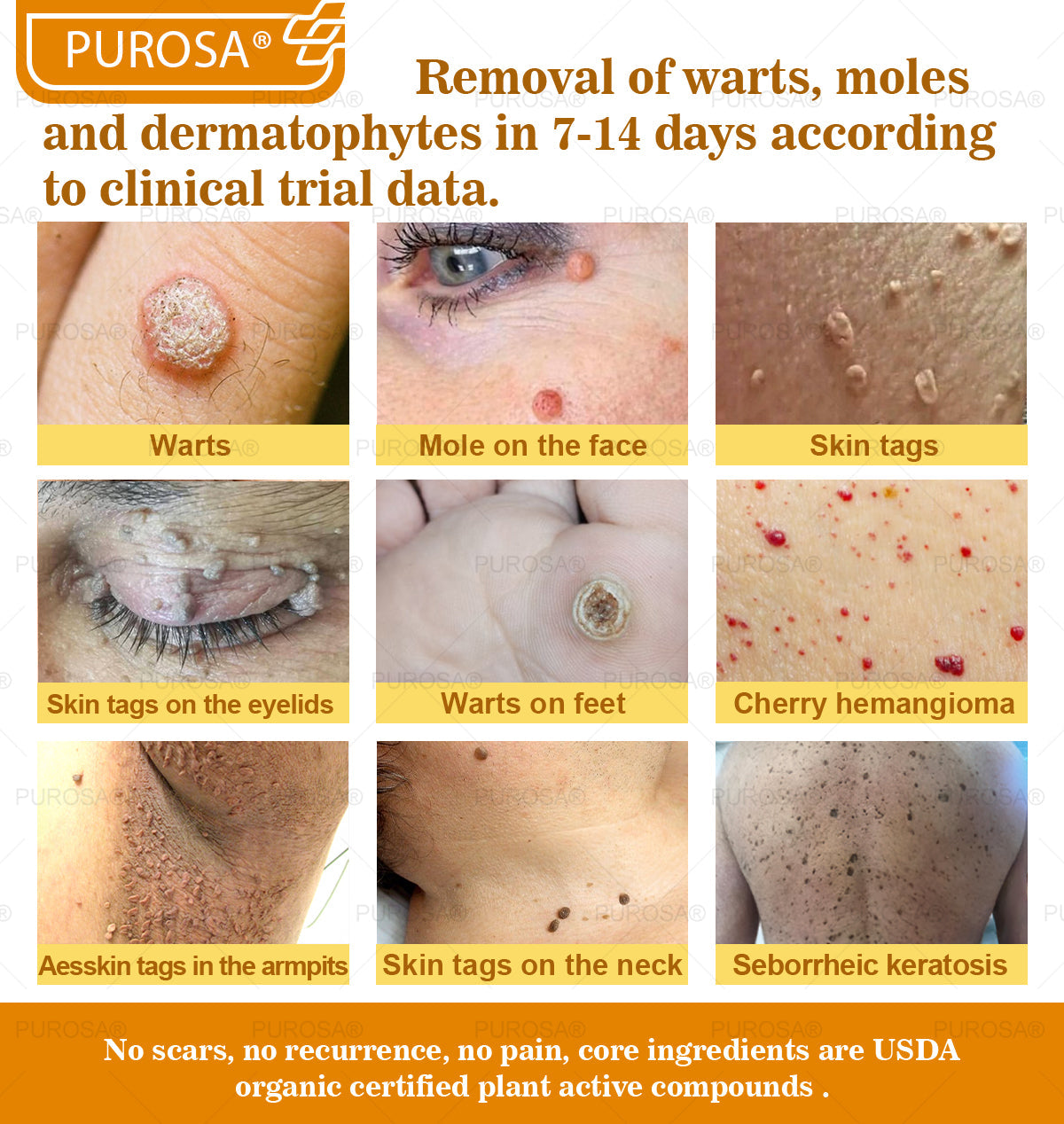 PUROSA® Bee Venom Skin Repair Cream(Visible results in 7 days✅Anti-Aging·Firming·Deep Hydration·Damage Repair·Even Tone·Acne&Dark Spot Care·Wart & Mole Reduction·Psoriasis Relief)